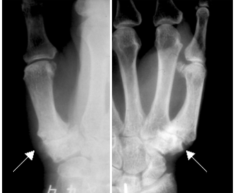 母指CM関節症（親指の付け根の関節の変形性関節症）